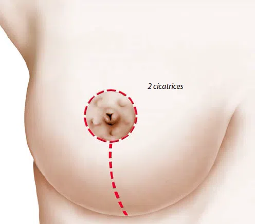Dessin d un sein de femme montrant les 2 cicatrices Reduction mammaire | Dr Christophe Reinbold Lyon