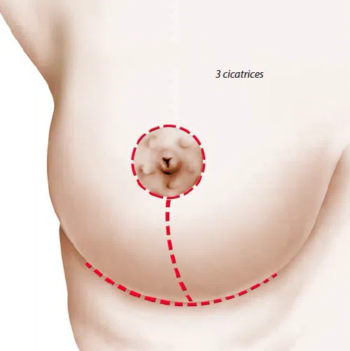 Dessin d un sein de femme montrant les 3 cicatrices en Forme T Reduction mammaire | Dr Christophe Reinbold Lyon