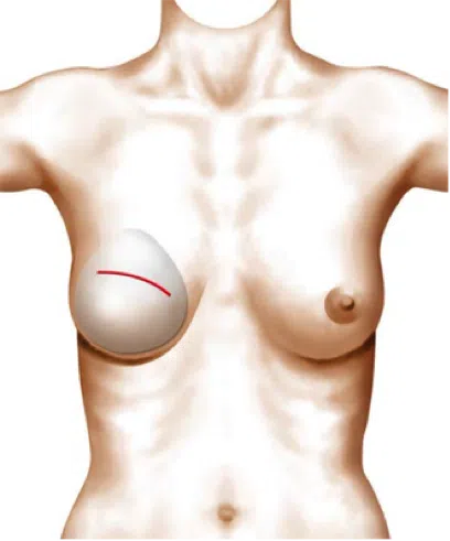 Dessin de poitrine d une femme montrant l emplacement d implant reconstruction mammaire par protheses | Dr Christophe Reinbold Lyon