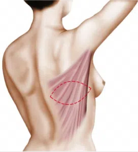 Dessin du dos d une femme montrant le lambeau de grand dorsal reconstruction mammaire | Dr Christophe Reinbold Lyon