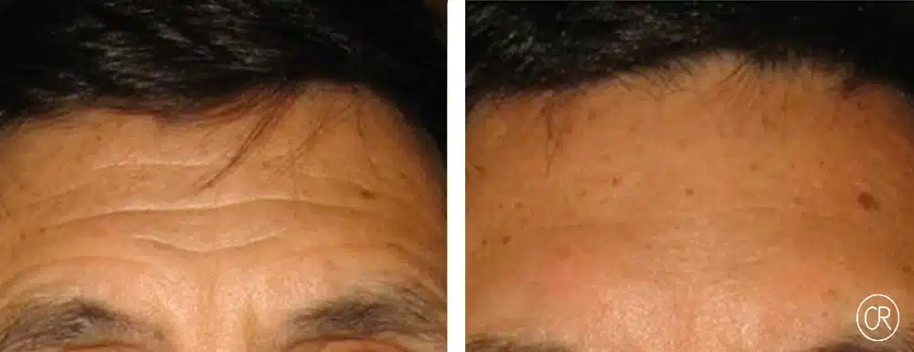 Photo rapprochee du front d un homme Avant/Apres Botox | Dr Christophe Reinbold Lyon