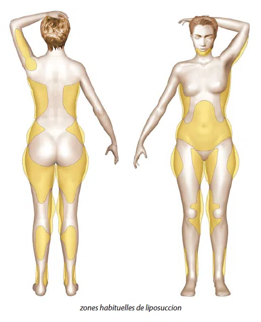 Dessin du corps d une femme par devant et par derriere montrant les zones habituelles de liposuccion | Dr Christophe Reinbold Lyon