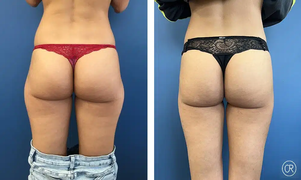 Fesses de femme Avant/Apres liposuccion | Dr Christophe Reinbold Lyon
