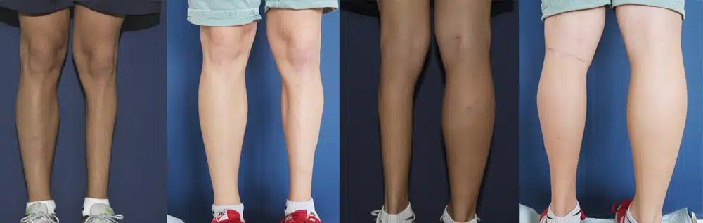 Photos des jambes d un homme avant/apres athrophie acquise de jambe | Dr Christophe Reinbold Lyon