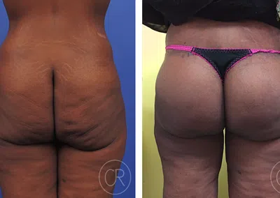 Fesses de femme noire avant/apres lifting de fesses | Dr Christophe Reinbold Lyon