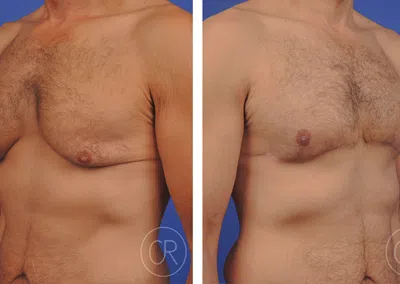 Torse et abdomen d un homme avant/apres gynecomastie | Dr Christophe Reinbold Lyon