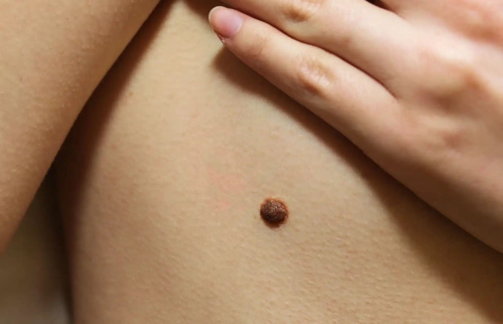 Grain de beaute sur la peau d une femme Tumeurs benignes et cancer de la peau | Dr Christophe Reinbold Lyon