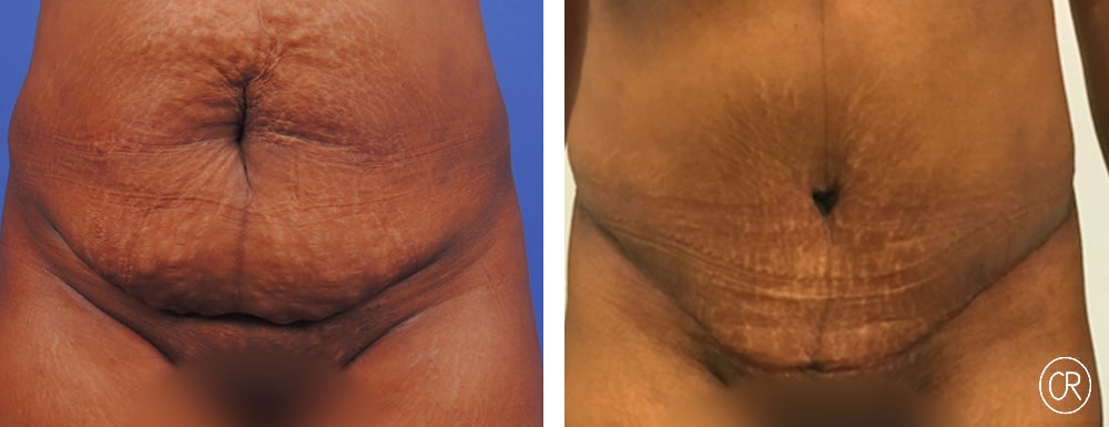 ventre d une femme brune avant/apres abdominoplastie | Dr Christophe Reinbold Lyon