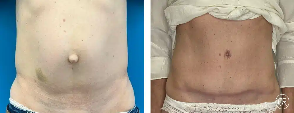 ventre d une femme avant/apres abdominoplastie | Dr Christophe Reinbold Lyon