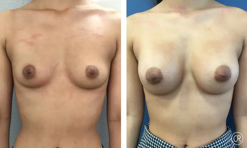 Photo Avant et après d’une augmentation mammaire composite Implants MOTIVA 315 chez une femme adulte- Dr Reinbold | Lyon