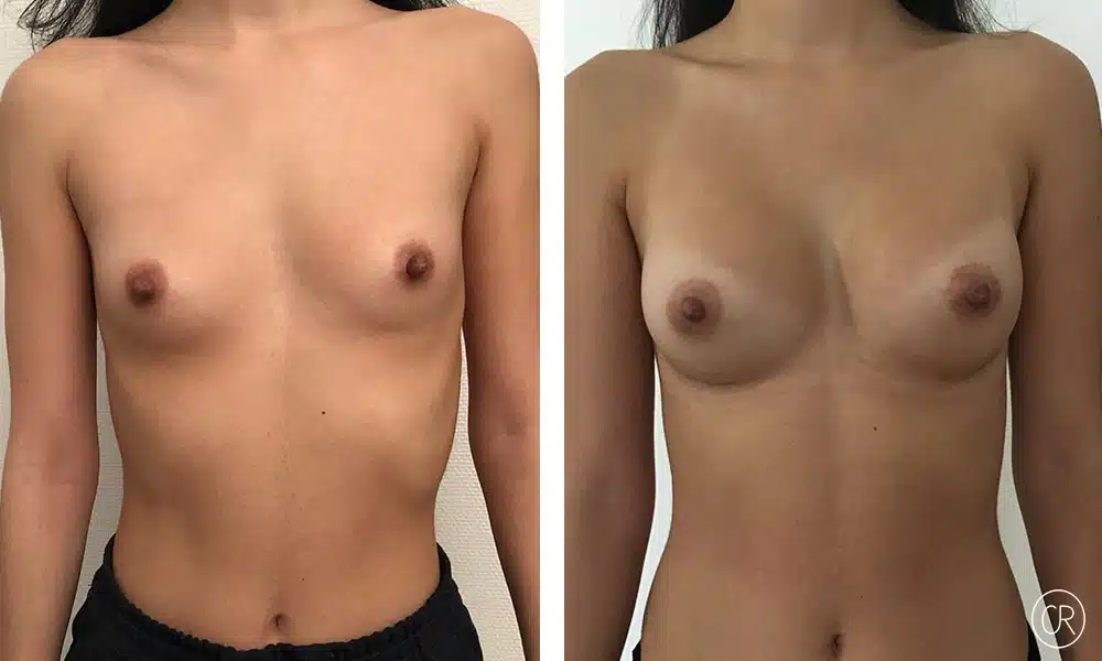 Avant et après d’une augmentation mammaire composite Implants MOTIVA 295 chez une jeune femme - Dr Reinbold | Lyon