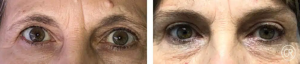 Photo rapprochee sur les yeux d une femme d age moyen avant/apres blepharoplastie | Dr Christophe Reinbold Lyon