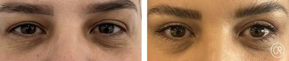 Photo rapprochee des yeux d un homme Avant/Apres blepharoplastie | Dr Christophe Reinbold Lyon