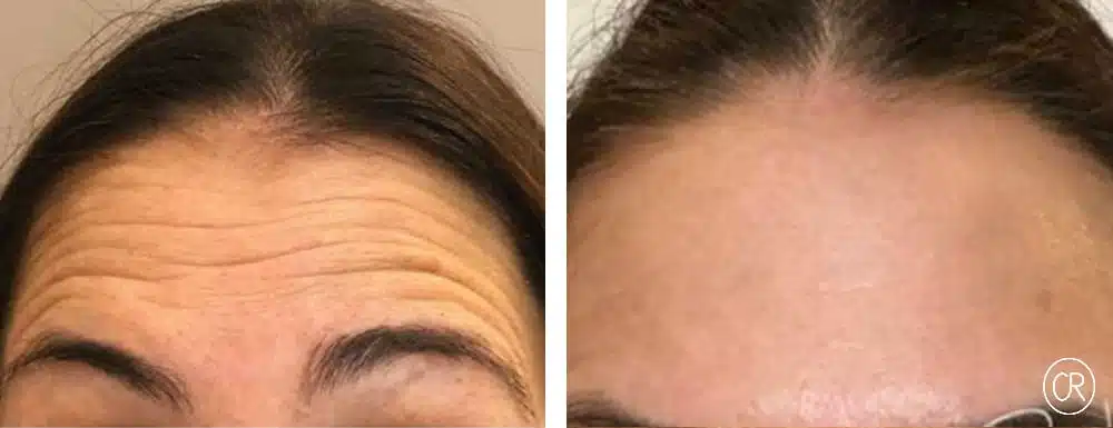 Front d une femme de moyen age avant/apres injections de botox | Dr Christophe Reinbold Lyon