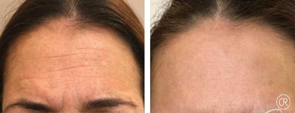 Photo du front d une femme de moyen age avant/apres injections de botox | Dr Christophe Reinbold Lyon
