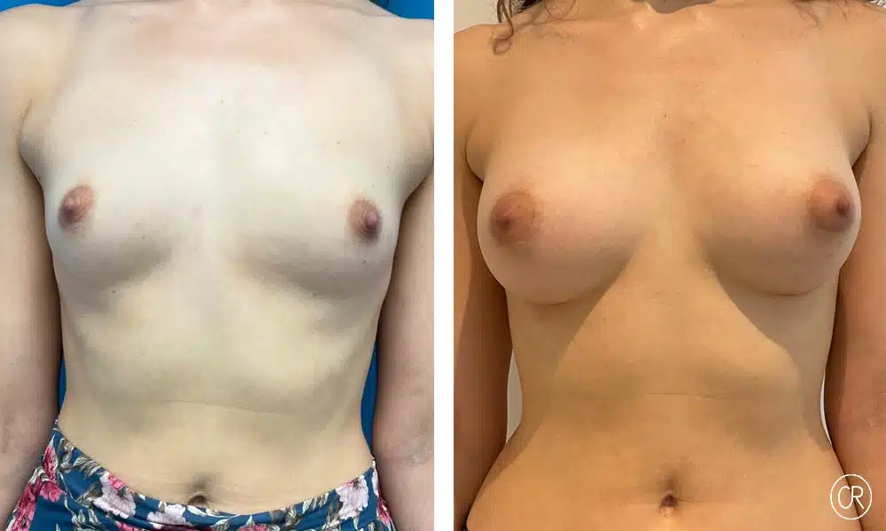 Photo sur la poitrine nu d'une femme avant et après d'une augmentation mammaire composite avec prothése de 285 - Dr Reinbold | Lyon
