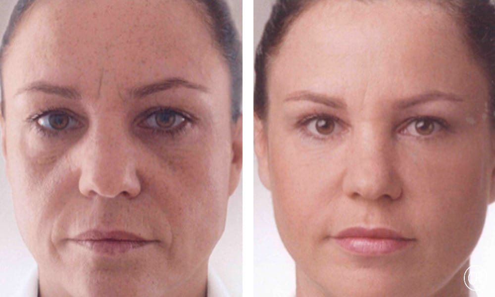Visage d une femme d age moyen avant/apres injections d acide hyaluronique | Dr Christophe Reinbold Lyon