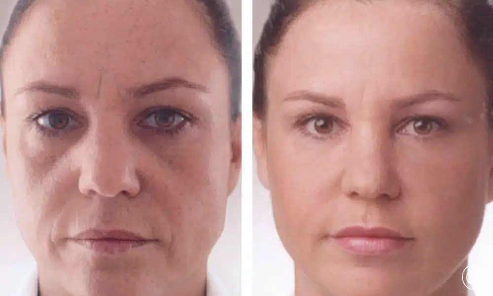 Visage d une femme d age moyen avant/apres injections d acide hyaluronique | Dr Christophe Reinbold Lyon