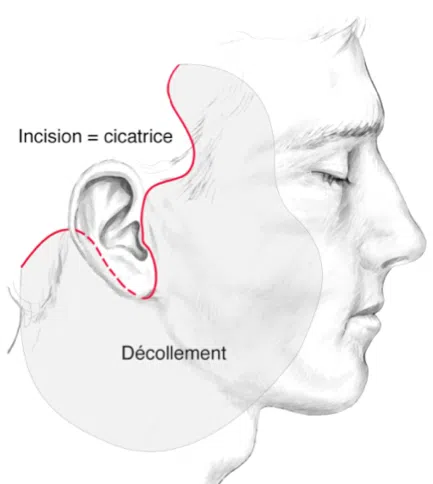 Dessin du visage d un homme montrant les zones de cicatrices lifting cervico facial | Dr Christophe Reinbold Lyon