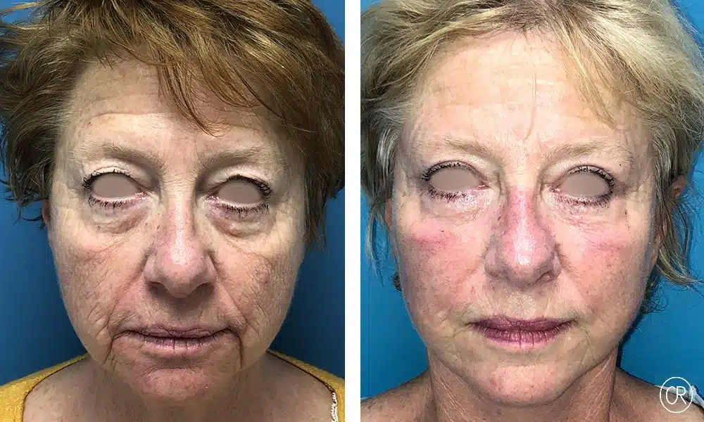 Image du visage d une femme agee avant/apres lifting visage et cou | Dr Christophe Reinbold Lyon