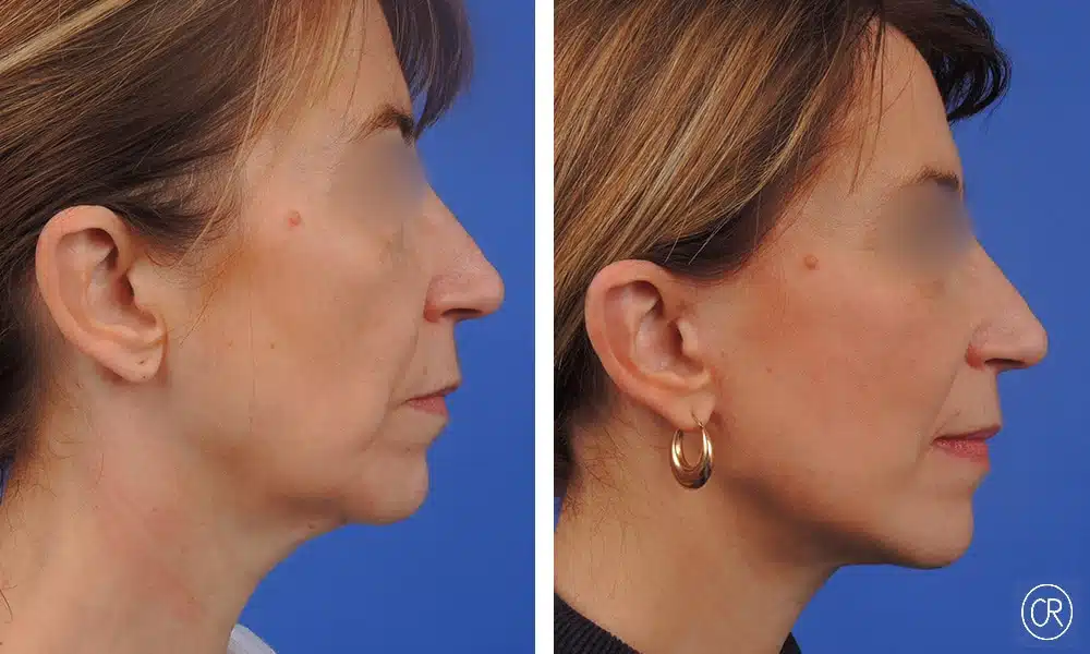 Image de profile droit du visage d une femme d age moyen avant/apres lifting visage et cou | Dr Christophe Reinbold Lyon