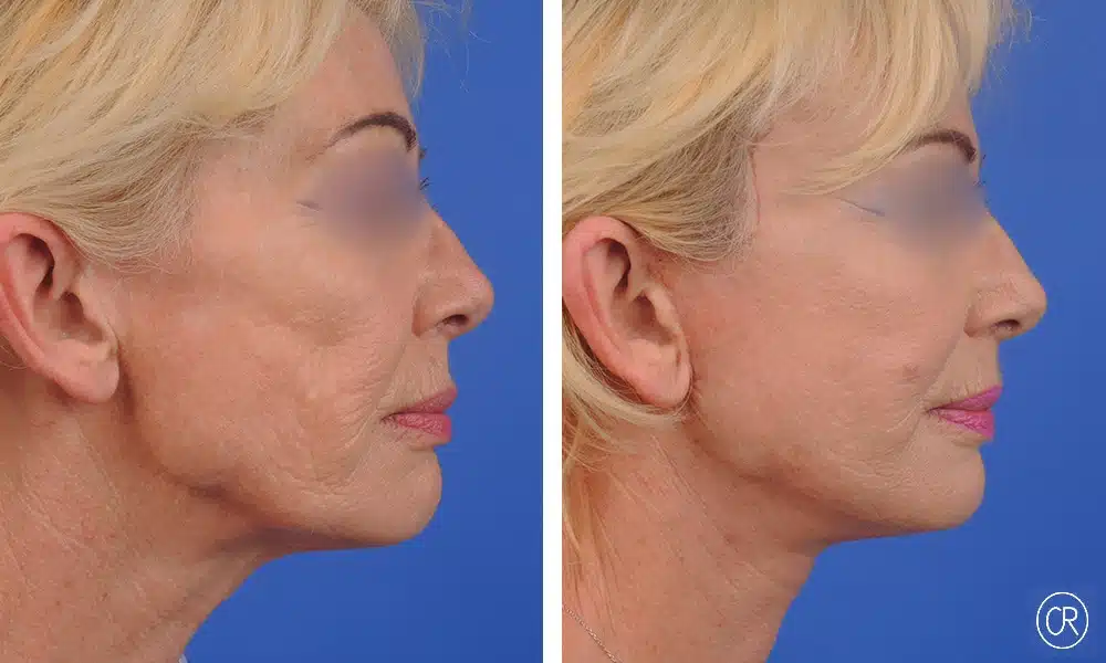 Image de profile droit du visage d une femme d age moyen avant/apres lifting visage et cou | Dr Christophe Reinbold Lyon