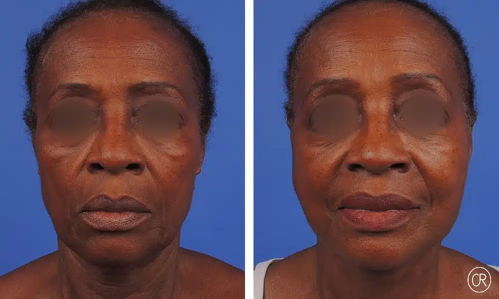 Image du visage d une femme noire avant/apres lifting visage et cou | Dr Christophe Reinbold Lyon
