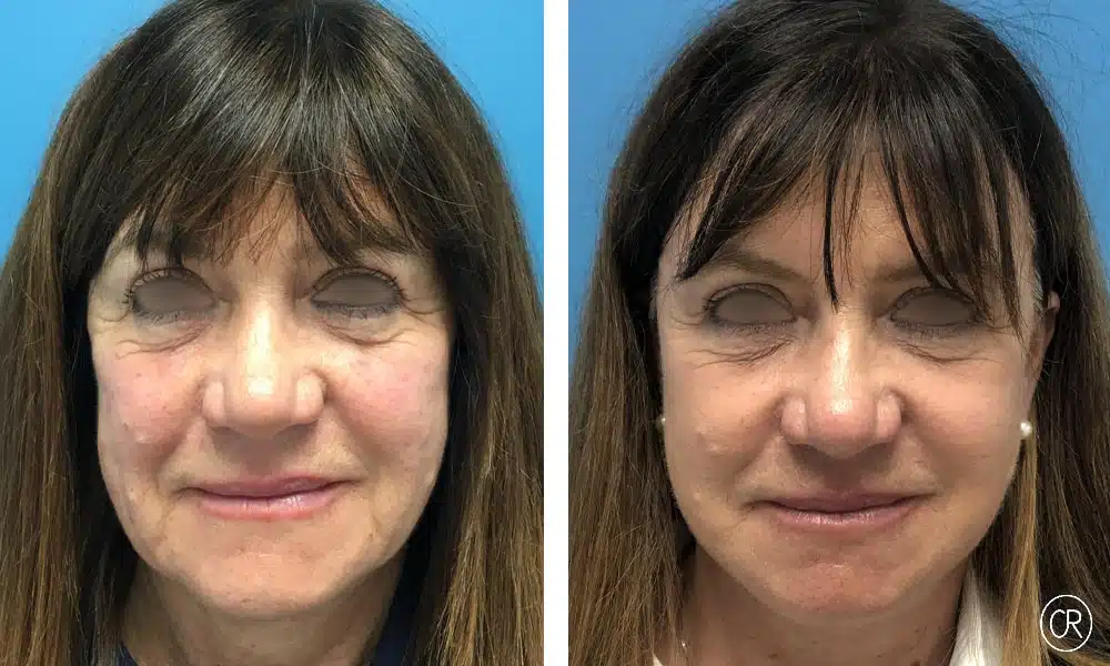 Image du visage d une femme d age moyen avant/apres lifting visage et cou | Dr Christophe Reinbold Lyon