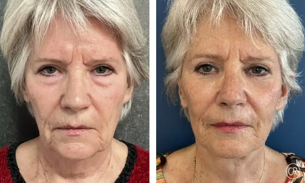 Photo du visage d une femme agee avant/apres lifting visage et cou | Dr Christophe Reinbold Lyon