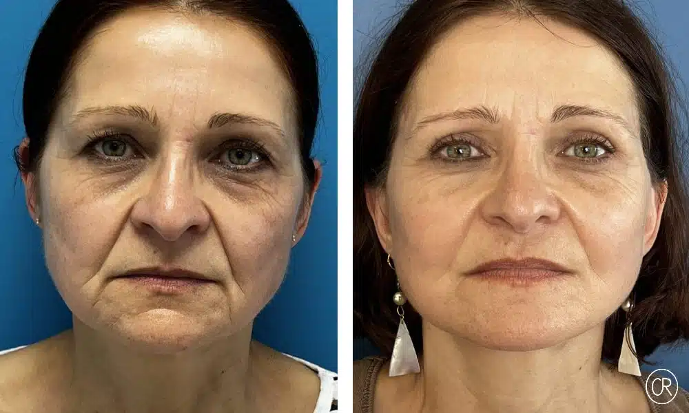 Photo du visage d une femme d age moyen avant/apres lifting visage et cou | Dr Christophe Reinbold Lyon