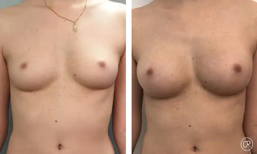 Poitrine et ventre d une jeune femme avant/apres lipofilling des seins | Dr Christophe Reinbold Lyon