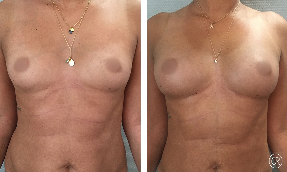Poitrine et ventre d une jeune femme avant/apres lipofilling des seins | Dr Christophe Reinbold Lyon