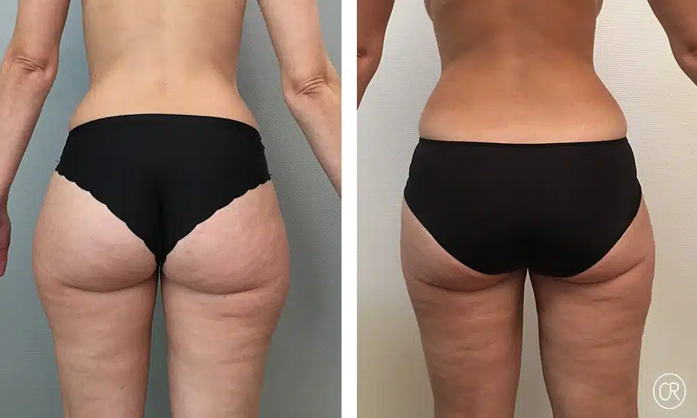 Photo de fesses d une jeune femme avant/apres Liposuccion | Dr Christophe Reinbold Lyon