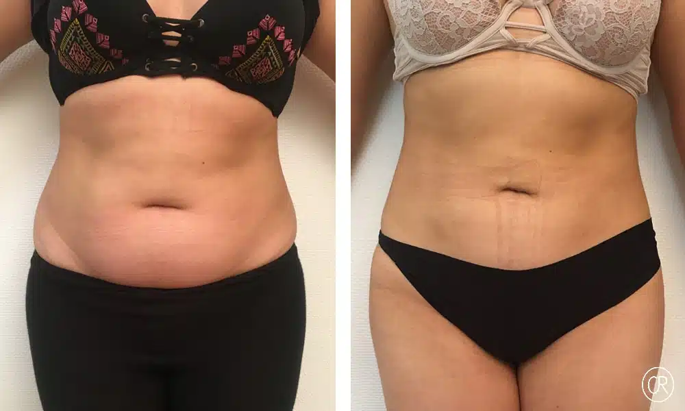 Photo du ventre d une femme de moyen age avant/apres liposuccion | Dr Christophe Reinbold Lyon