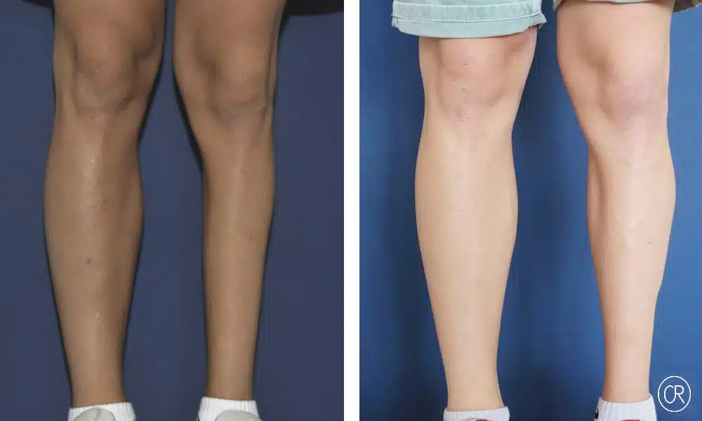 Photo des genoux d une femme avant/apres malformation des mollet | Dr Christophe Reinbold Lyon