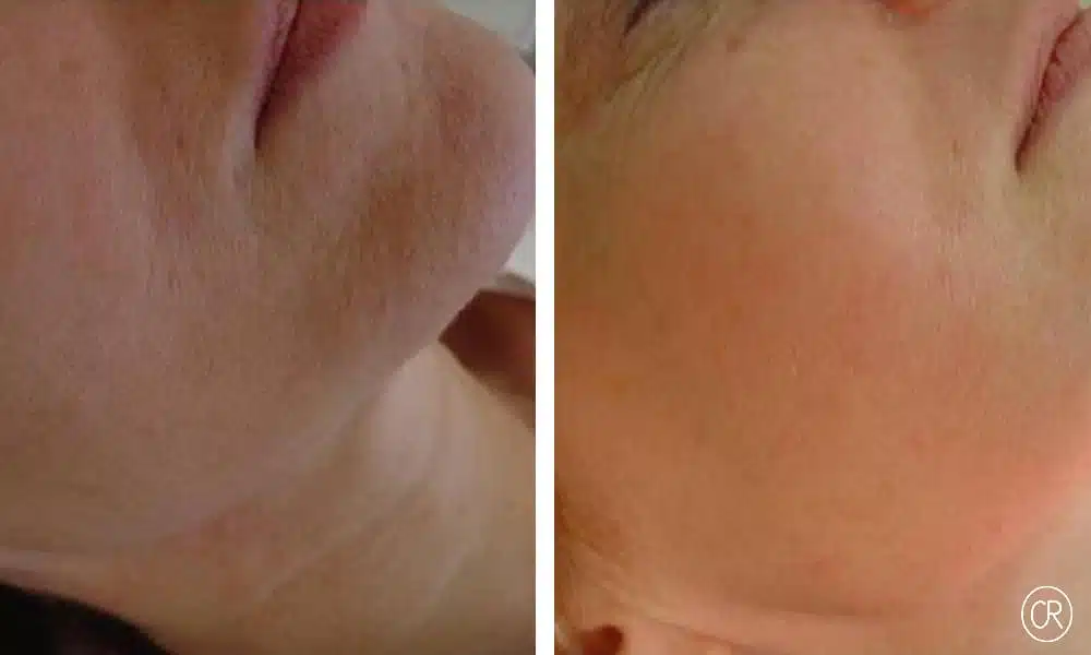 Photo rapprochee sur la joue d une femme avant/apres Peeling | Dr Christophe Reinbold Lyon