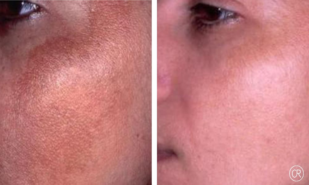 Vue rapprochee sur la joue d un homme avant/apres Peeling | Dr Christophe Reinbold Lyon