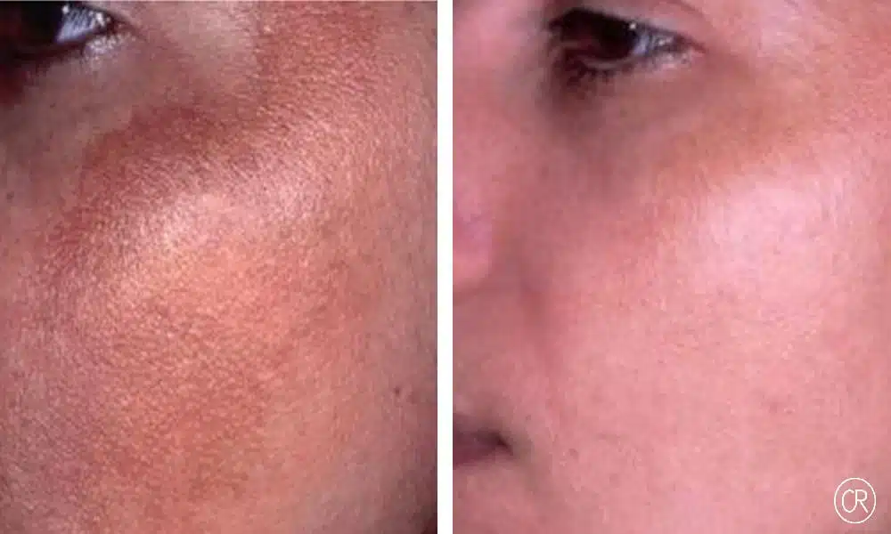 Vue rapprochee sur la joue d un homme avant/apres Peeling | Dr Christophe Reinbold Lyon