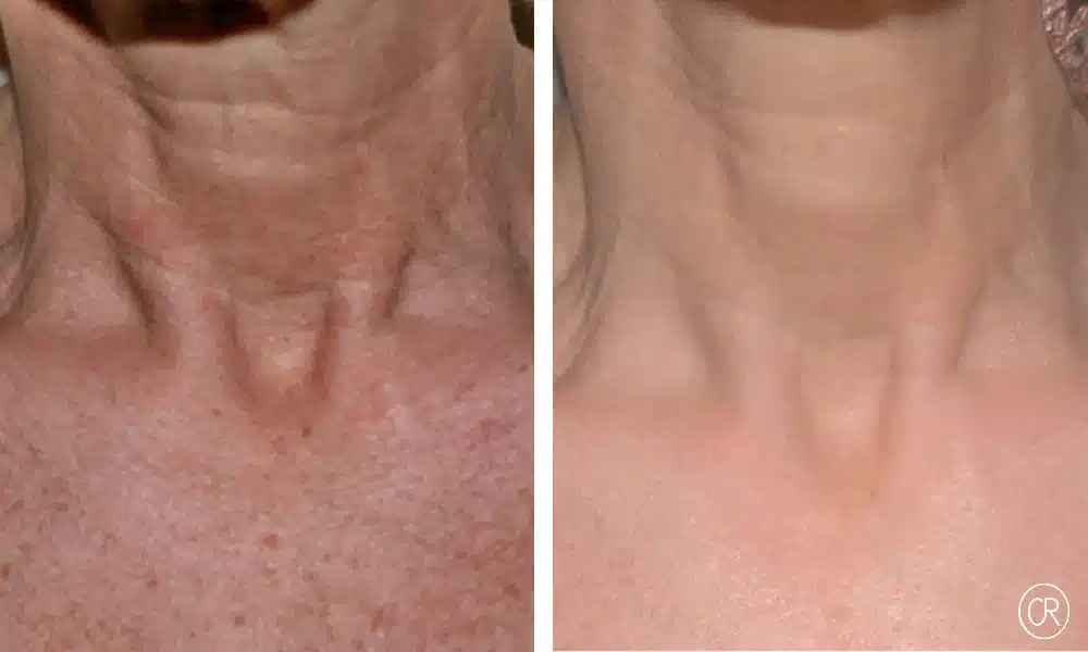 Photo rapprochee sur le cou d une femme avant/apres Peeling | Dr Christophe Reinbold Lyon