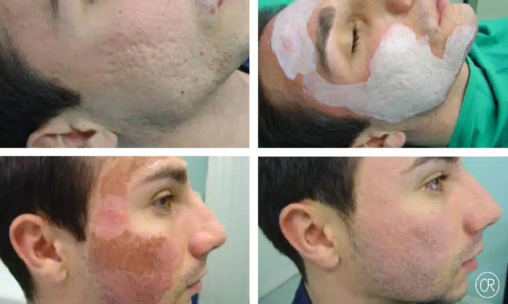 Visage d un homme de profile droit avant/apres Peeling| Dr Christophe Reinbold Lyon
