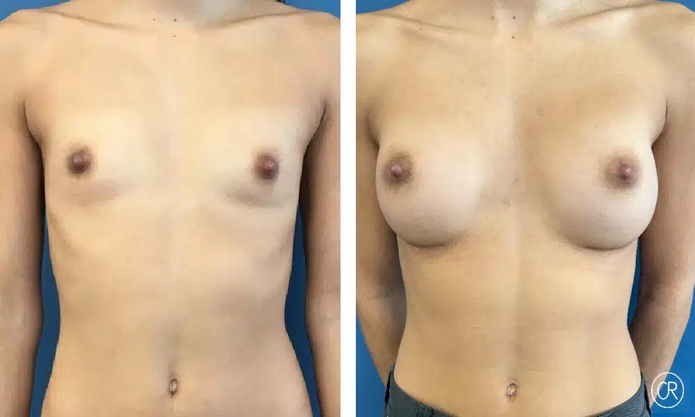 Photo avant et après d'une augmentation mammaire composite avec prothése de 230, vue de face sur la poitrine nu - Dr Reinbold | Lyon