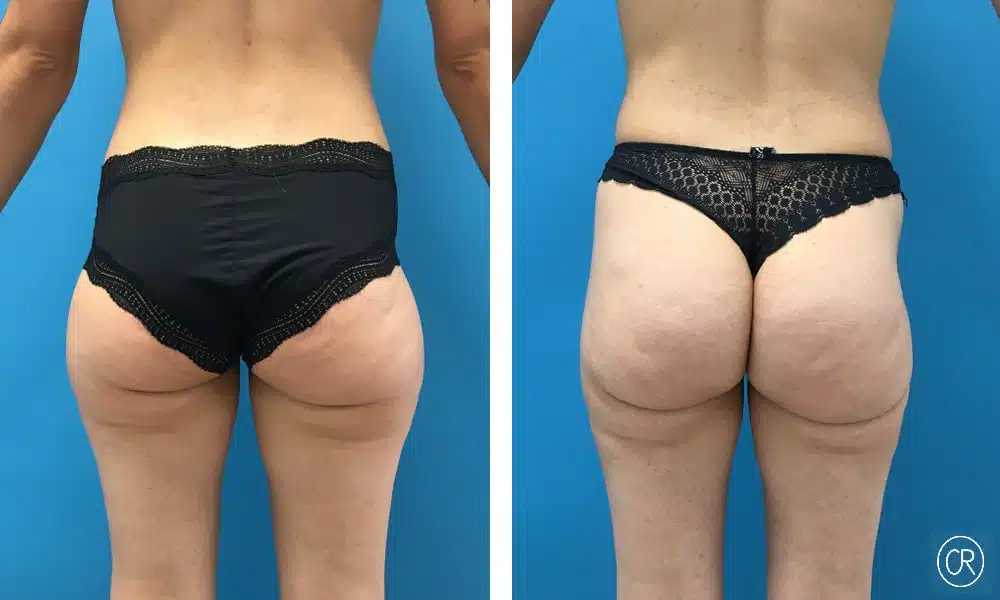 Fesses d une femme d age moyen avant/apres Liposuccion | Dr Christophe Reinbold Lyon