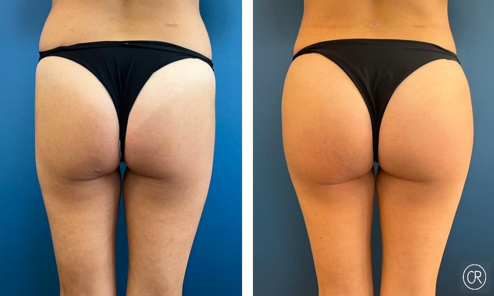 Fesses d une femme avant/apres pose de prothese fesses | Dr Christophe Reinbold Lyon