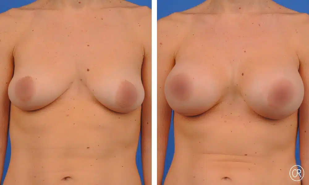 Seins d une jeune femme avant/apres augmentation mammaire par protheses | Dr Christophe Reinbold Lyon