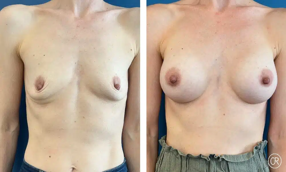 Photo Avant et après d’une femme - augmentation mammaire par prothèses de 230 - Dr Reinbold | Lyon