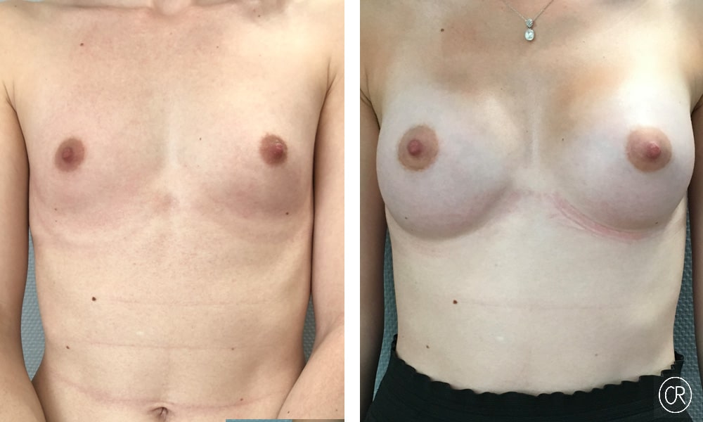 Seins d une jeune femme avant/apres protheses mammaire | Dr Christophe Reinbold Lyon