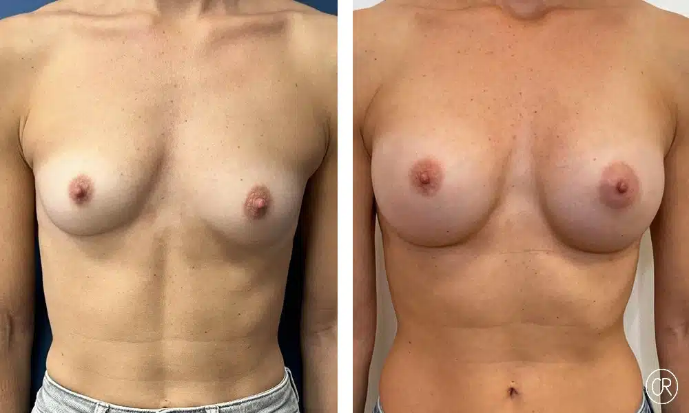 Poitrine d une jeune femme avant/apres protheses mammaire | Dr Christophe Reinbold Lyon
