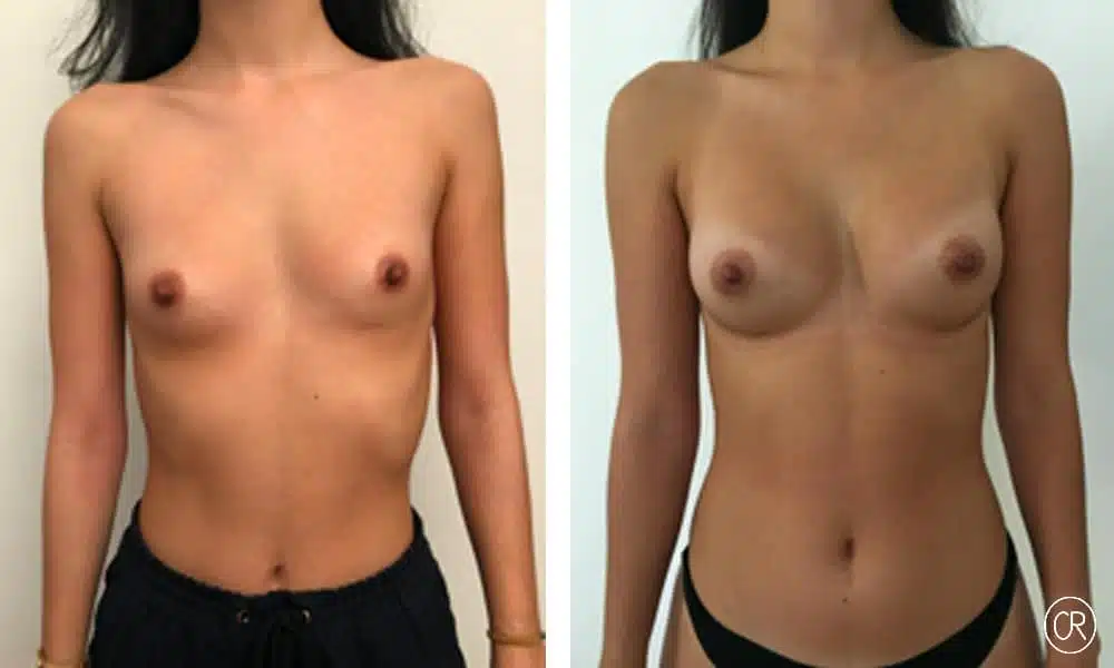 Seins d une jeune femme avant/apres protheses mammaire | Dr Christophe Reinbold Lyon