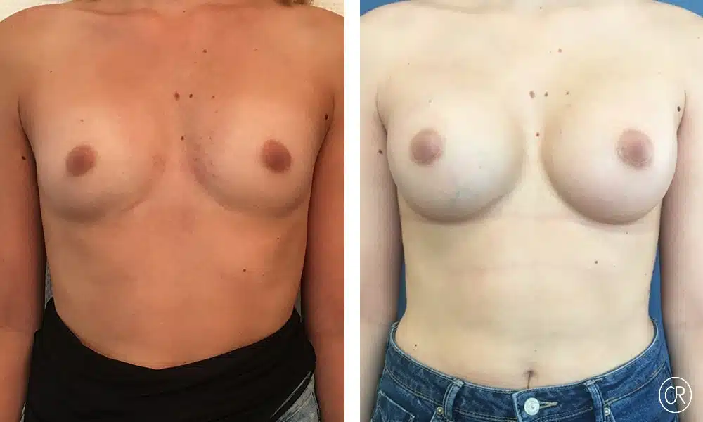 Poitrine d une jeune femme avant/apres protheses mammaire | Dr Christophe Reinbold Lyon