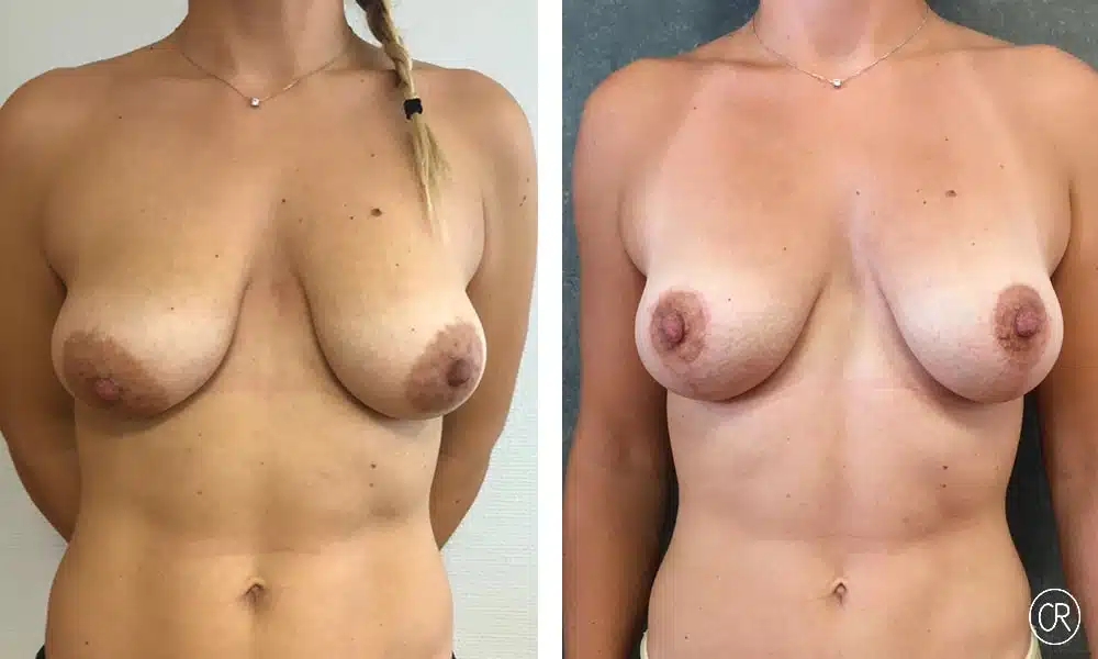 Poitrine d une femme avant/apres ptose mammaire | Dr Christophe Reinbold Lyon